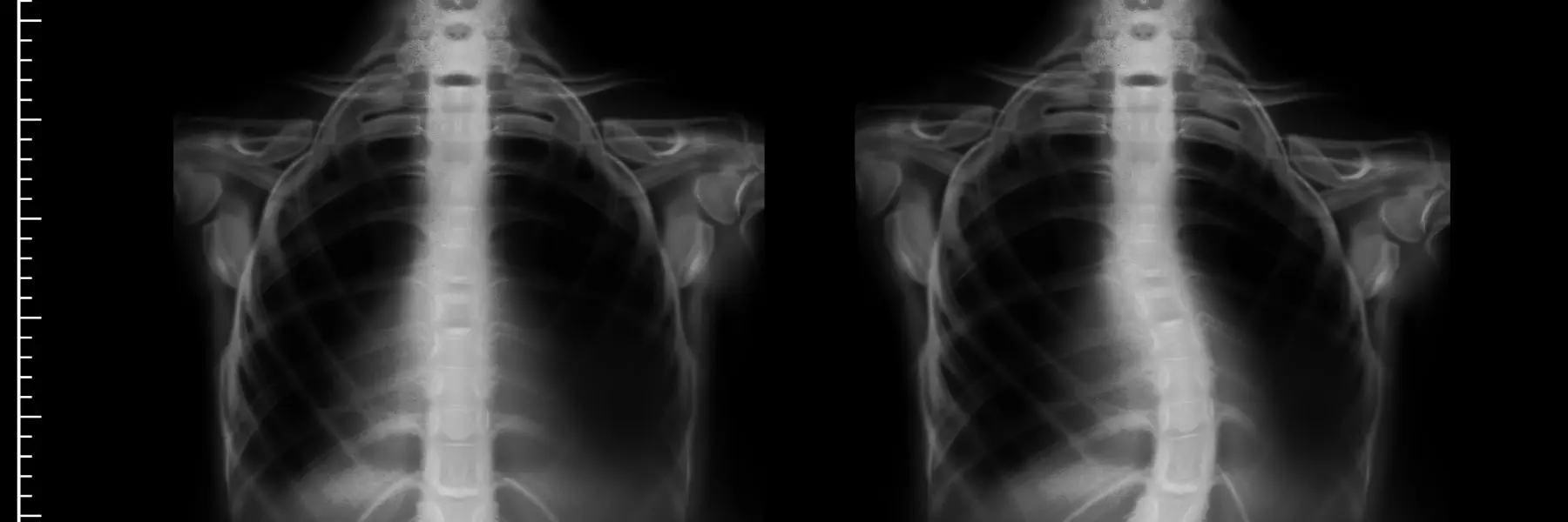Scoliosis Management Specialists