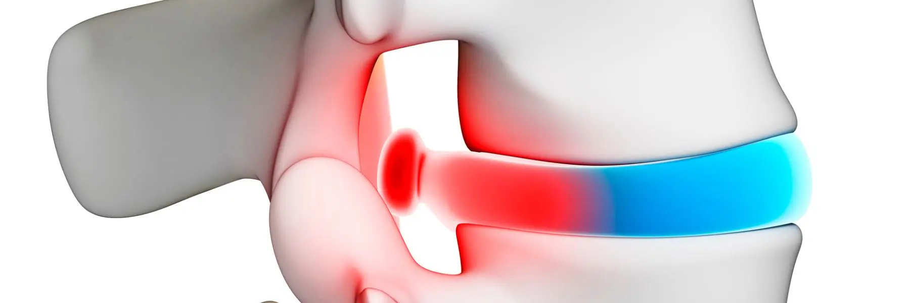 What Is the Best Treatment for Herniated Discs in Neck