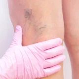 What Is Vascular Disease?