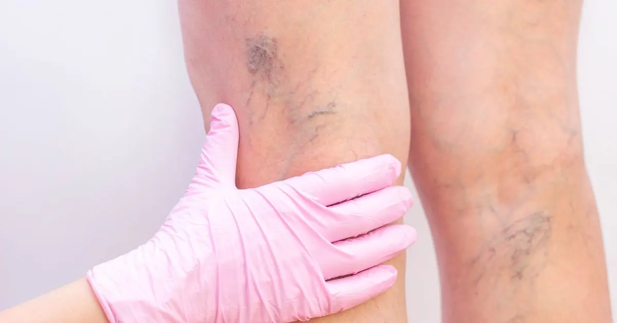 What Is Vascular Disease?